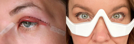 Blepharoplasty vs RevitalEyes: What’s Right for You?