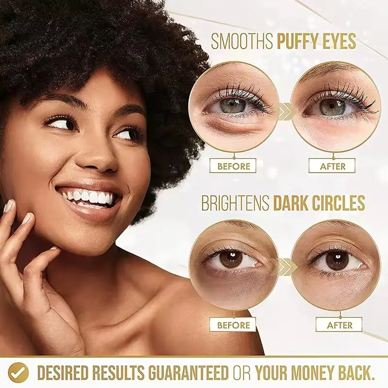 Dark Circles & Puffy eyes
