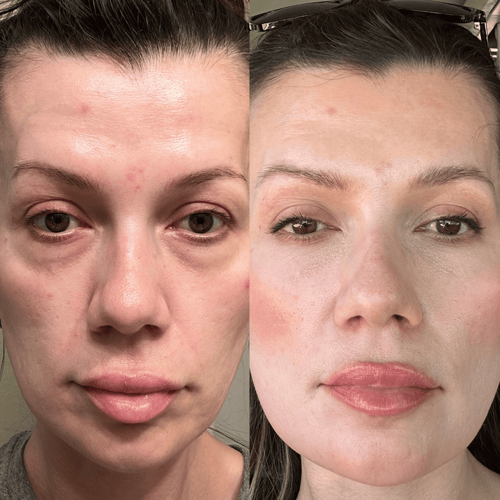 RevitalEyes® Under - Eye Red Light Therapy for Men - Botanique Paris