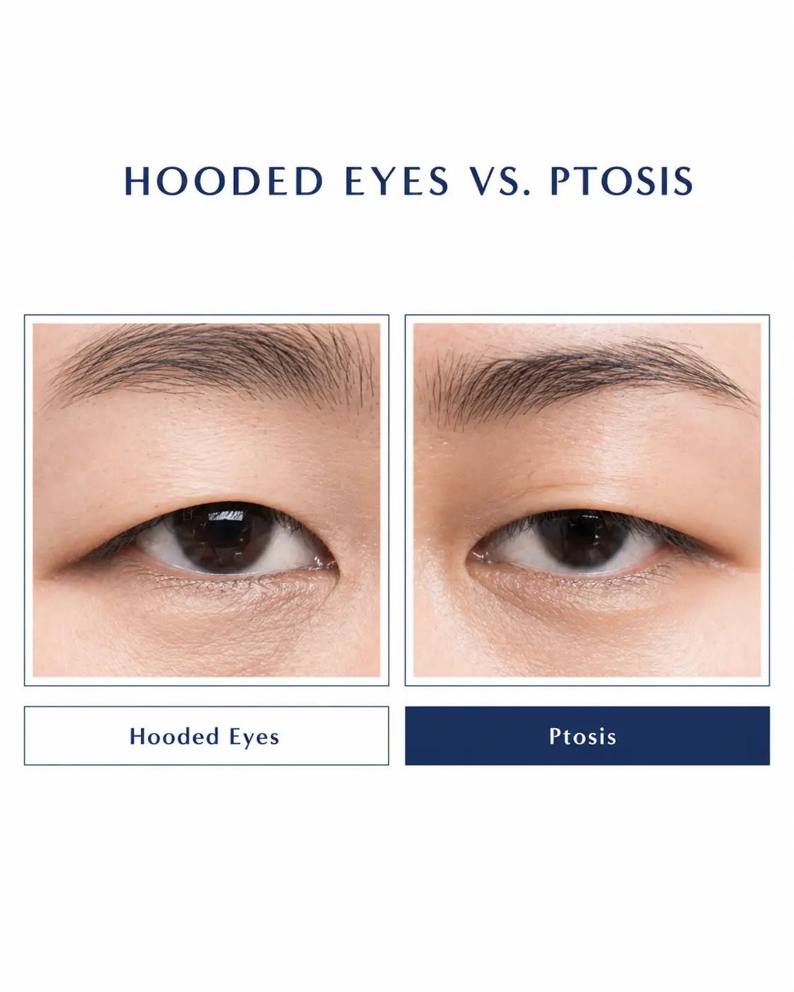 Ptosis vs Hooded Eyes: How to Tell Them Apart (and Fix It) - Botanique Paris