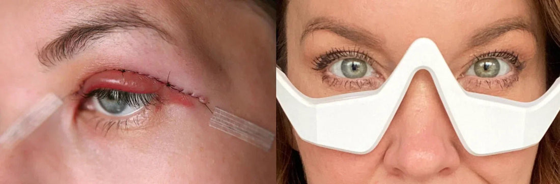 Blepharoplasty vs RevitalEyes: What’s Right for You? - Botanique Paris