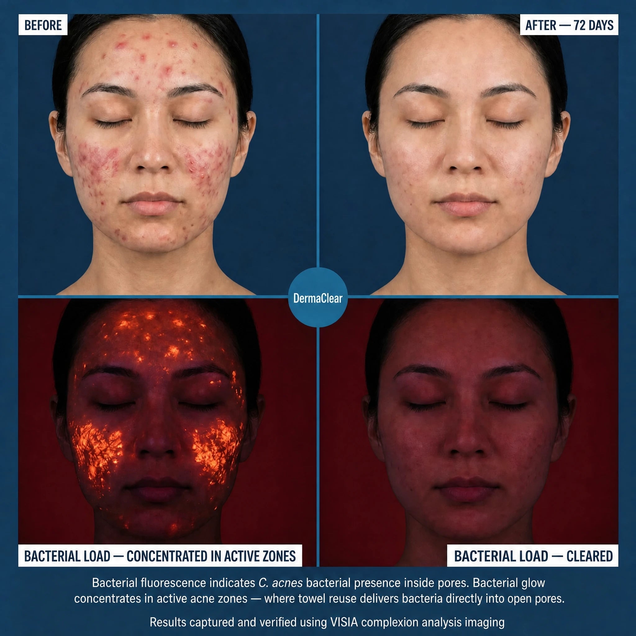 DermaClear™ Face Towels For Acne-Prone Skin - Botanique Paris