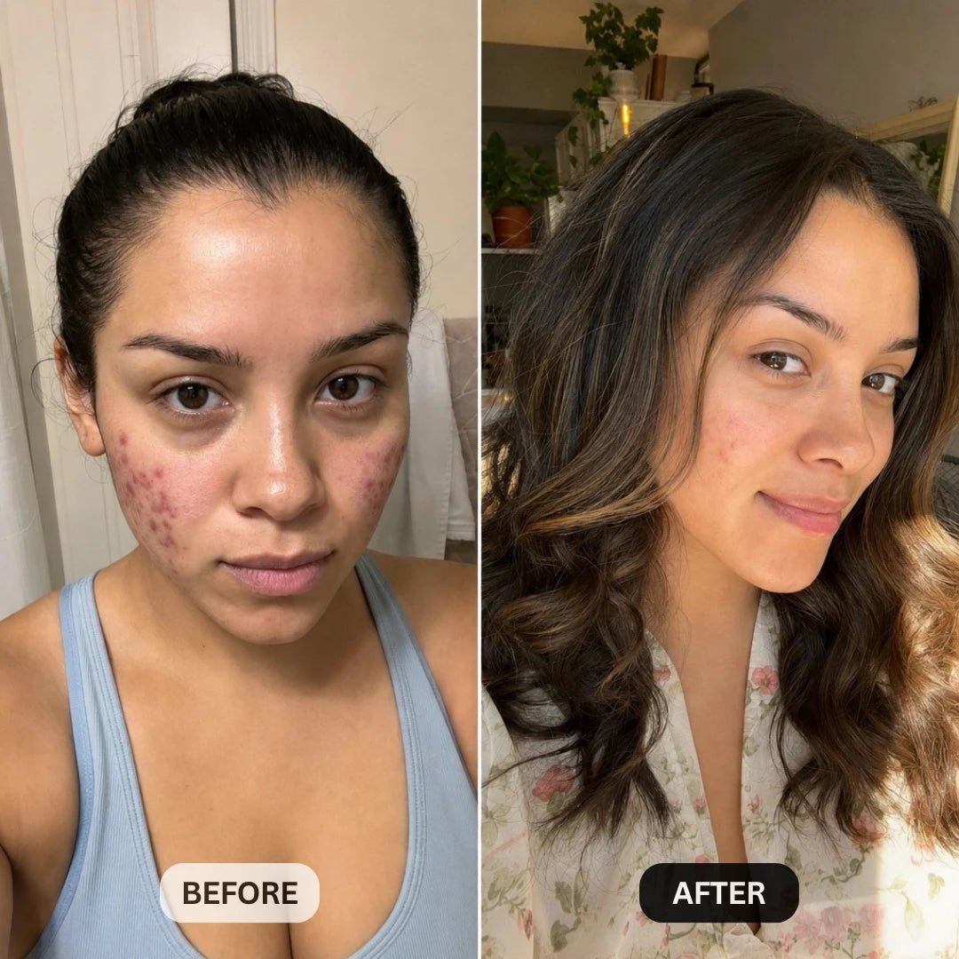 DermaClear™ Face Towels For Acne-Prone Skin - Botanique Paris