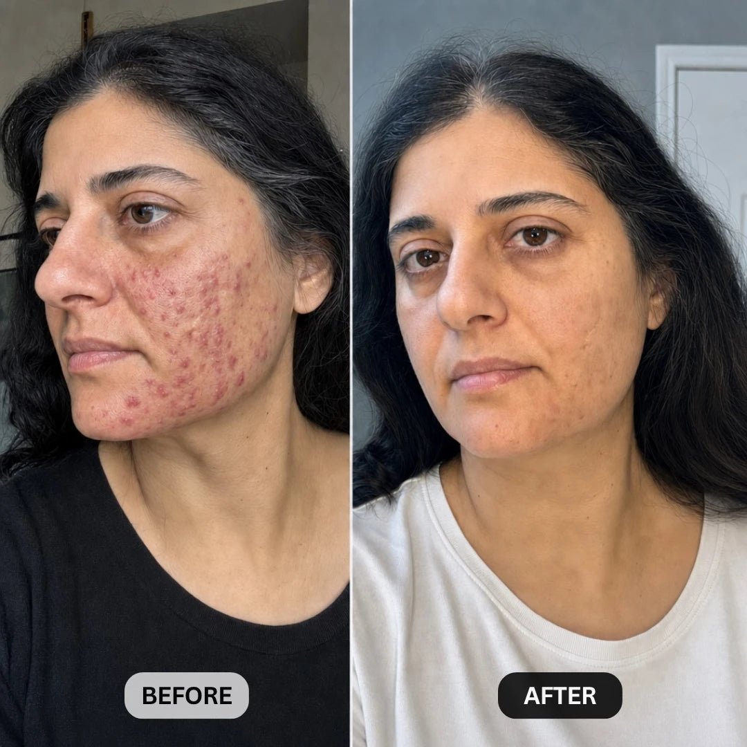 DermaClear™ Face Towels For Acne-Prone Skin - Botanique Paris