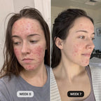 DermaClear™ Face Towels For Acne-Prone Skin - Botanique Paris