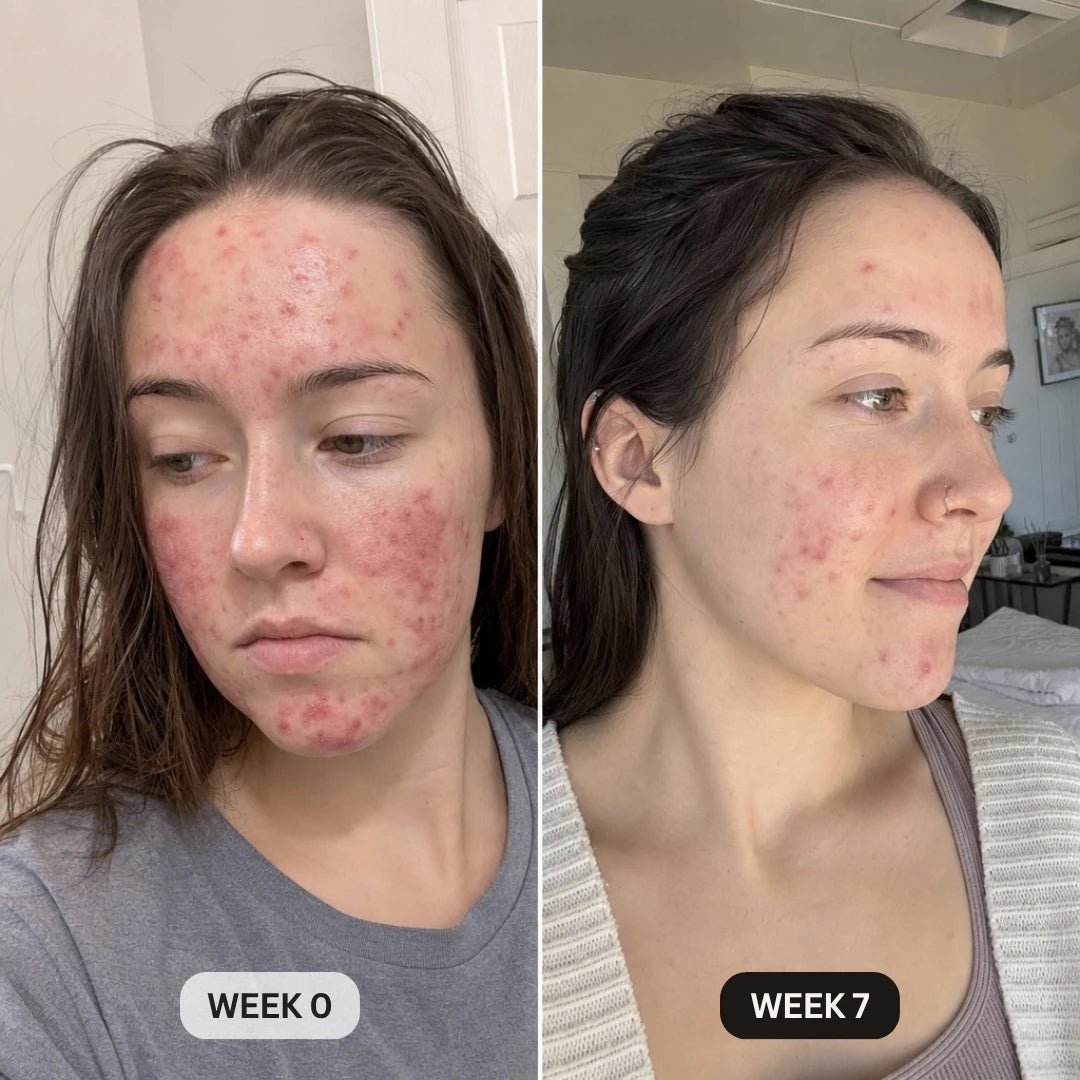 DermaClear™ Face Towels For Acne-Prone Skin - Botanique Paris