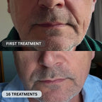 Micro - Infusion System For Smile Lines (Men) - Botanique Paris