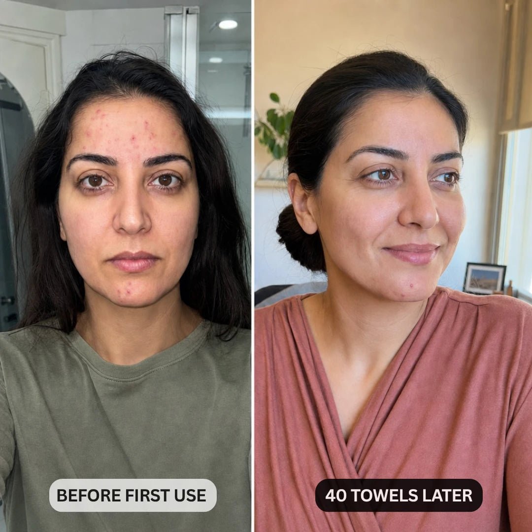 DermaClear™ Face Towels For Acne-Prone Skin - Botanique Paris