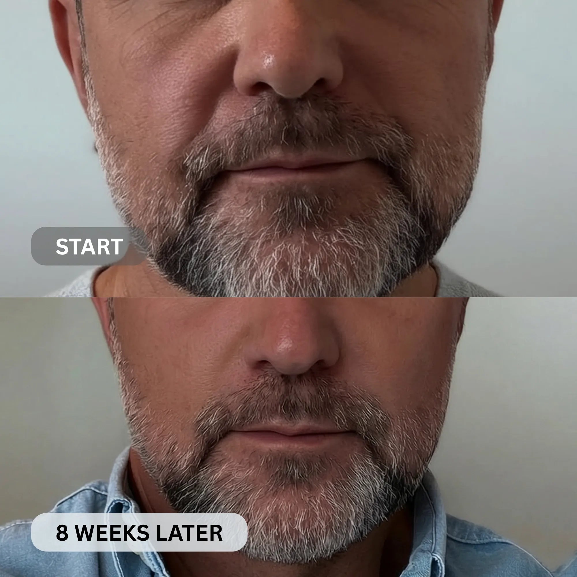 Micro - Infusion System For Smile Lines (Men) - Botanique Paris