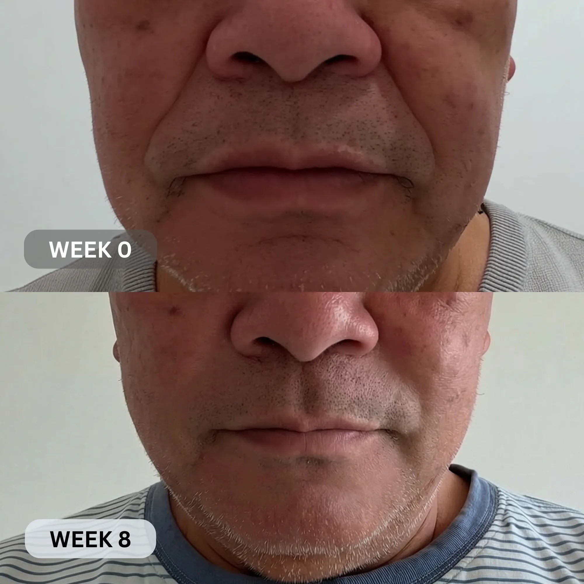 Micro - Infusion System For Smile Lines (Men) - Botanique Paris