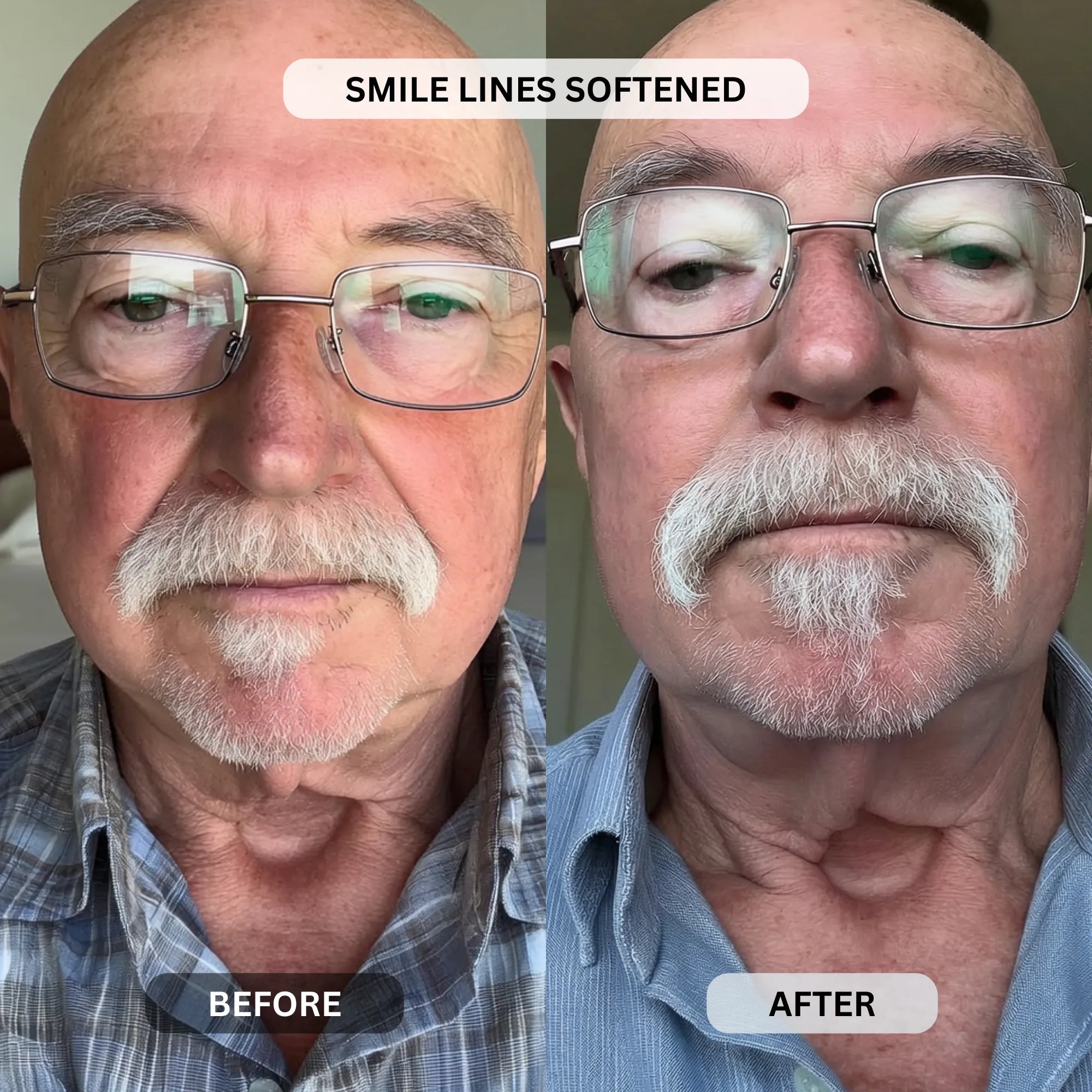 Micro - Infusion System For Smile Lines (Men) - Botanique Paris