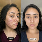 DermaClear™ Face Towels For Acne-Prone Skin - Botanique Paris