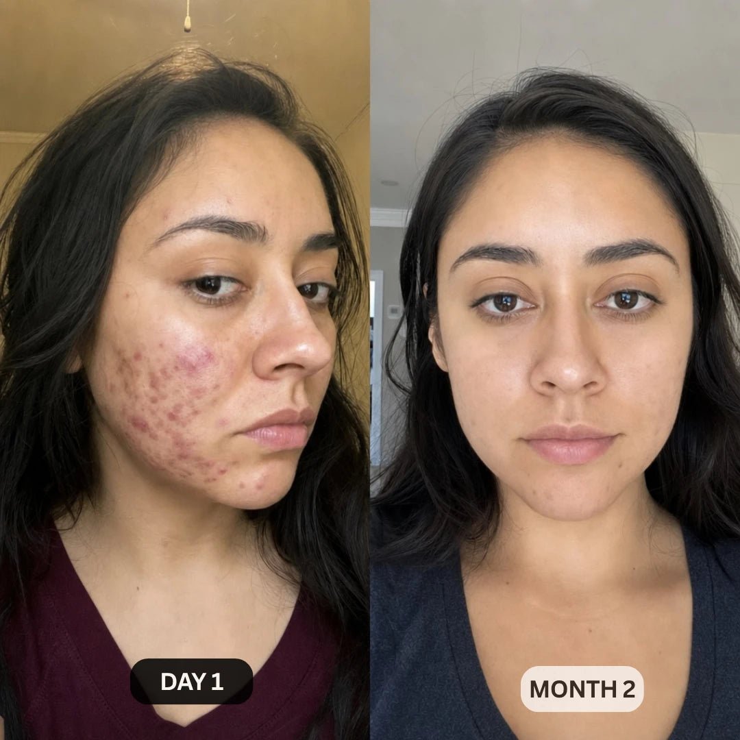 DermaClear™ Face Towels For Acne-Prone Skin - Botanique Paris