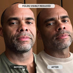 Micro - Infusion System For Smile Lines (Men) - Botanique Paris