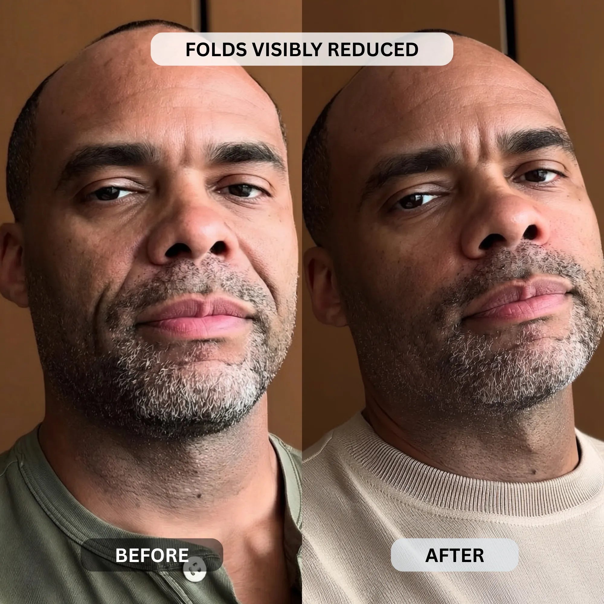 Micro - Infusion System For Smile Lines (Men) - Botanique Paris