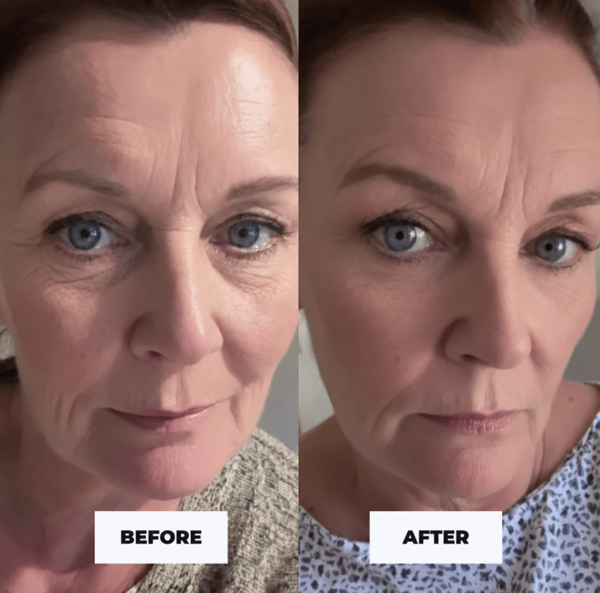 RevitalEyes® Korean Dermal Red Light Therapy + EMS To Erase Eye Wrinkles & Fine Lines - Botanique Paris