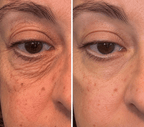 RevitalEyes® Korean Dermal Red Light Therapy + EMS To Erase Eye Wrinkles & Fine Lines - Botanique Paris