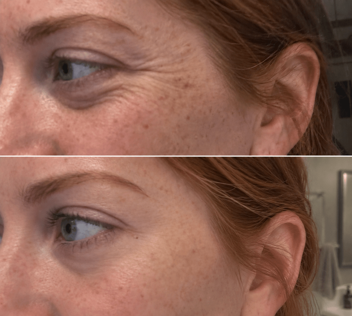 RevitalEyes® Korean Dermal Red Light Therapy + EMS To Erase Eye Wrinkles & Fine Lines - Botanique Paris