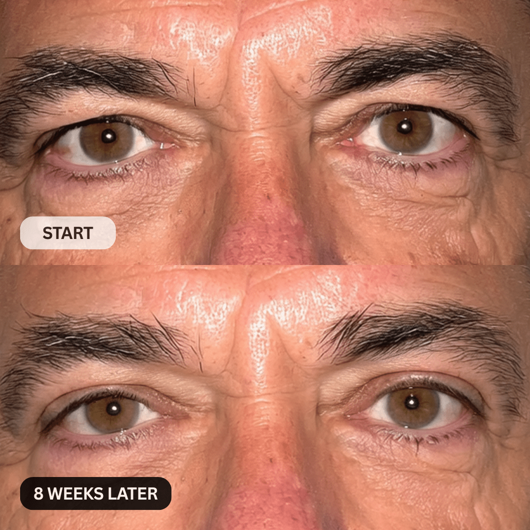 Upper eyelid close-up result
