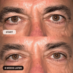 Micro - Infusion System For Upper Eyelids (Men) - Botanique Paris