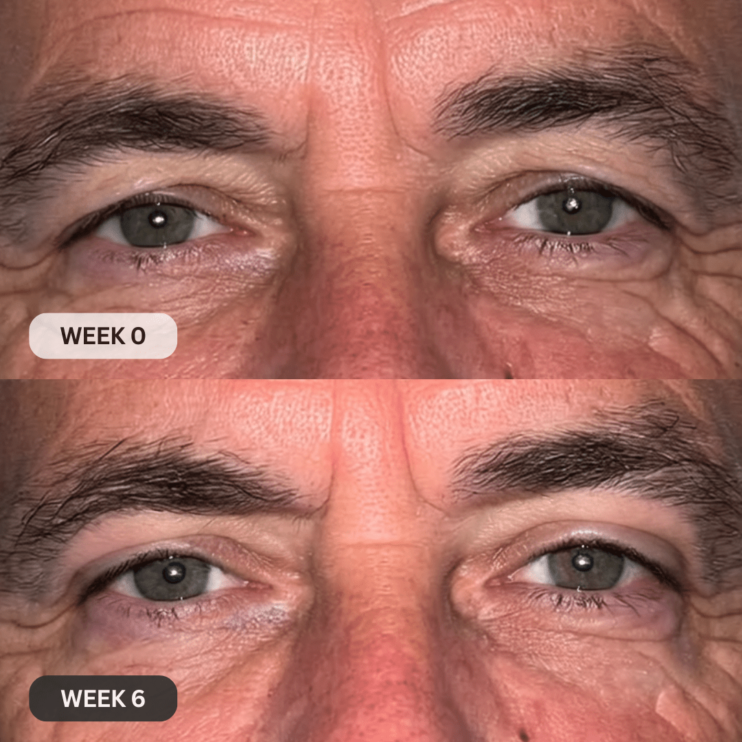 Upper eyelid close-up result