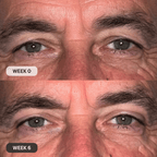 Micro - Infusion System For Upper Eyelids (Men) - Botanique Paris