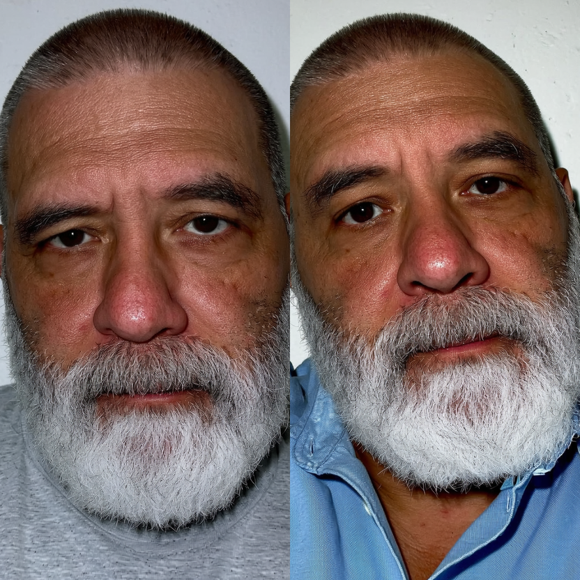 Before and after: firmer upper eyelids