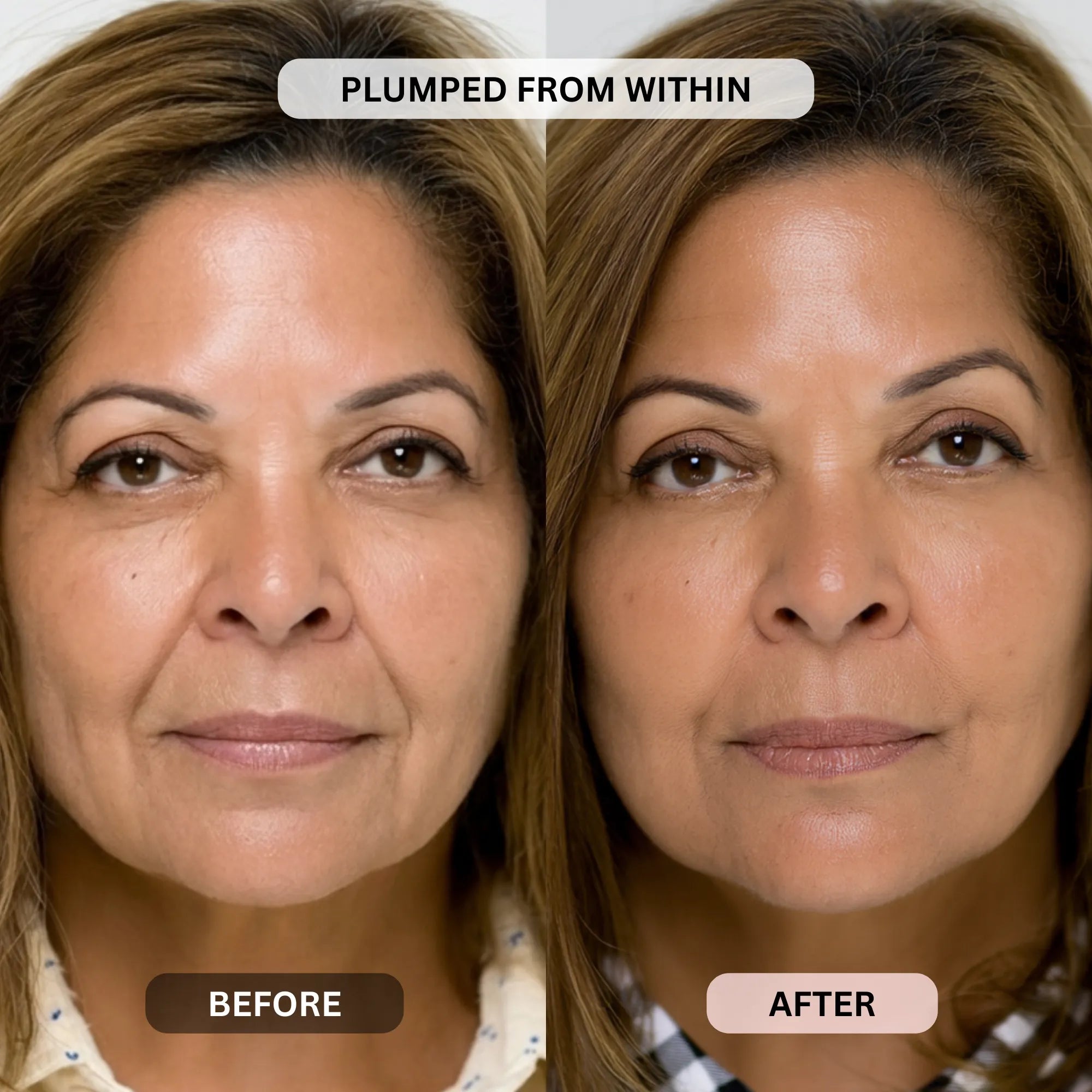 Micro - Infusion System For Smile Lines PDRN + Copper Peptide + NAD⁺ - Botanique Paris