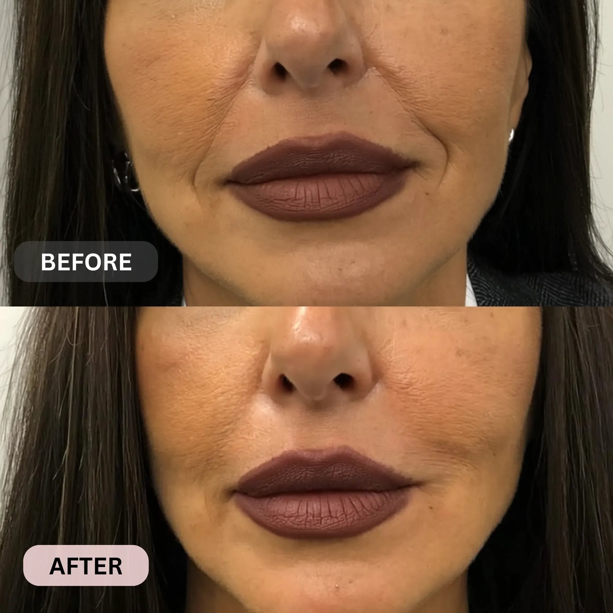 Micro - Infusion System For Smile Lines PDRN + Copper Peptide + NAD⁺ - Botanique Paris