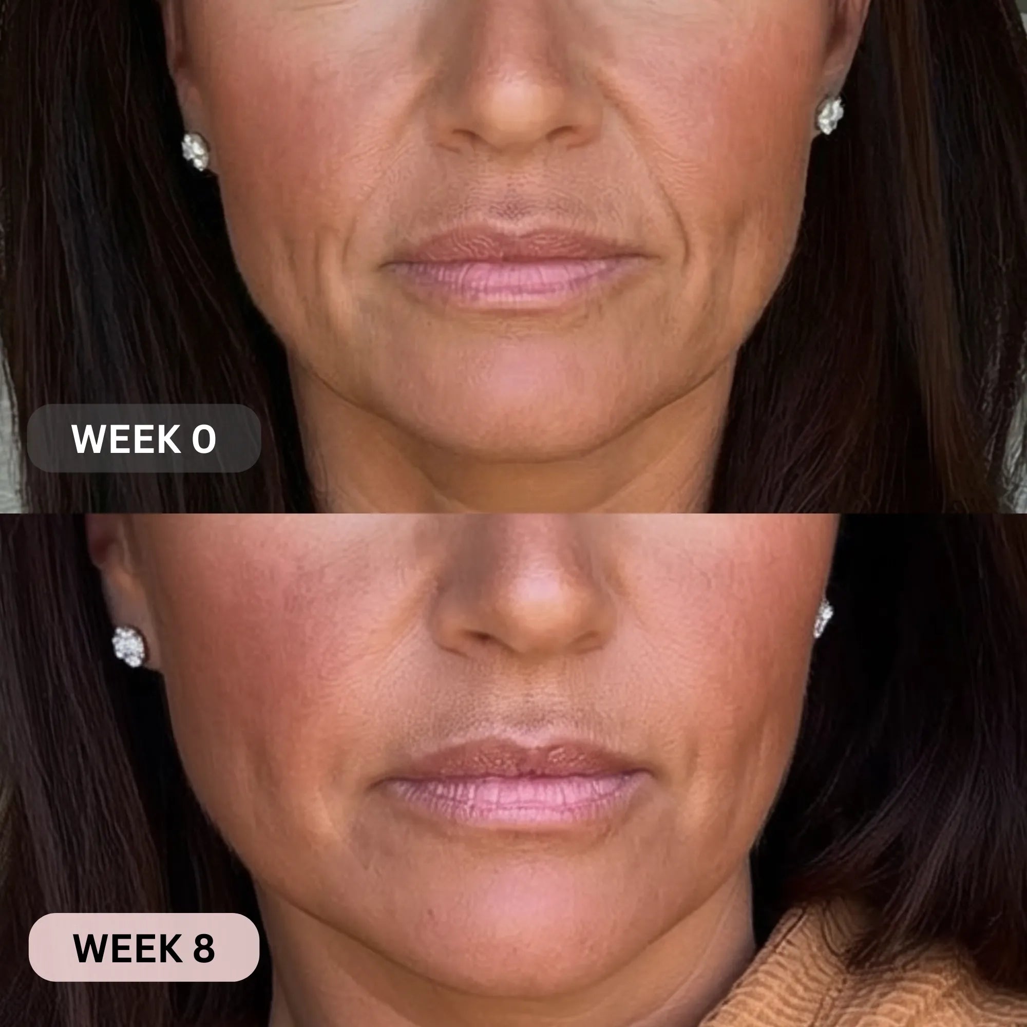 Micro - Infusion System For Smile Lines PDRN + Copper Peptide + NAD⁺ - Botanique Paris