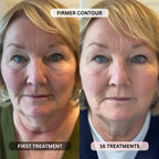 Micro-Infusion System For Smile Lines