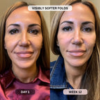 Micro - Infusion System For Smile Lines PDRN + Copper Peptide + NAD⁺ - Botanique Paris