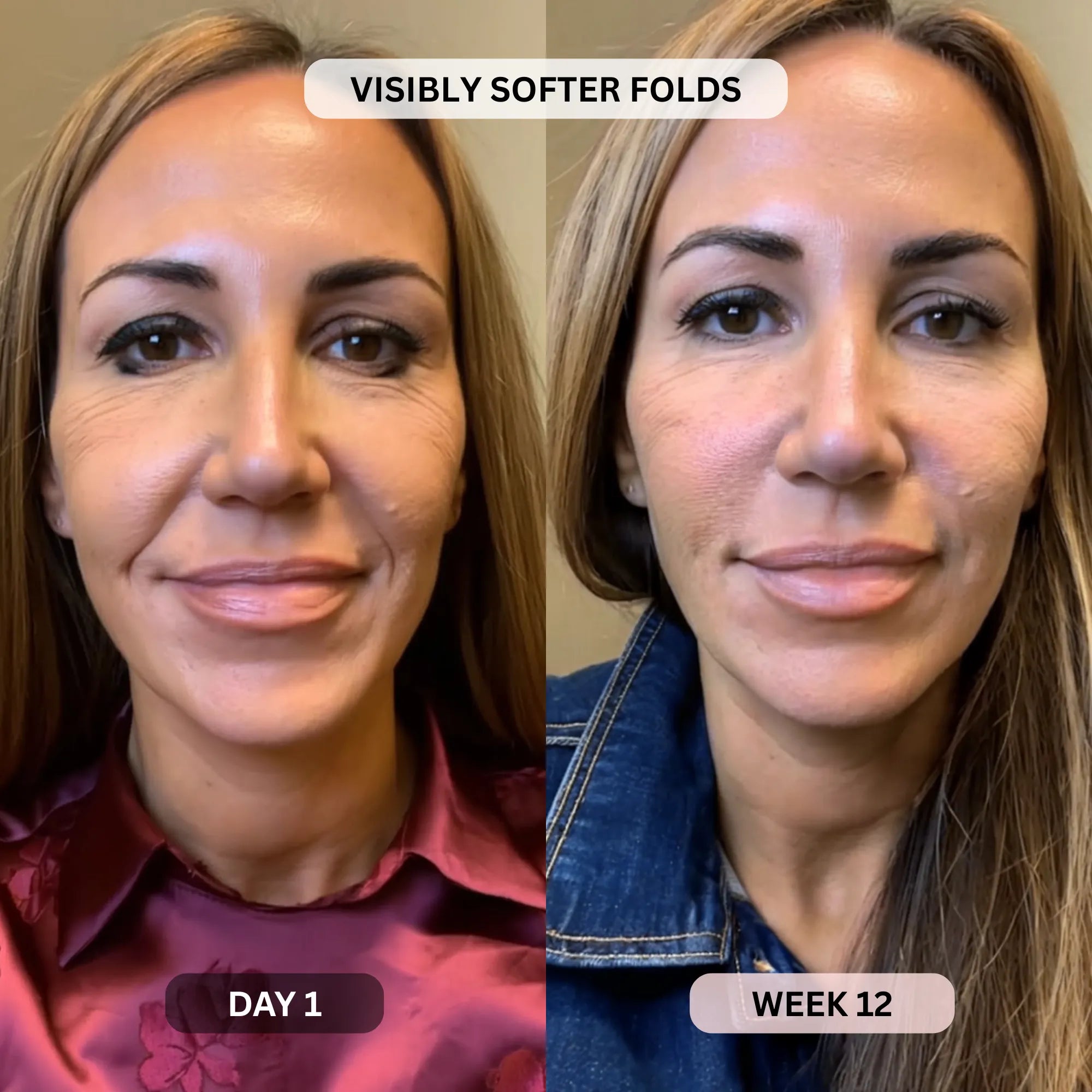 Micro - Infusion System For Smile Lines PDRN + Copper Peptide + NAD⁺ - Botanique Paris