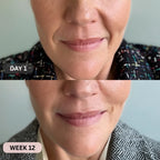 Micro - Infusion System For Smile Lines PDRN + Copper Peptide + NAD⁺ - Botanique Paris