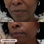 Micro - Infusion System For Smile Lines PDRN + Copper Peptide + NAD⁺ - Botanique Paris