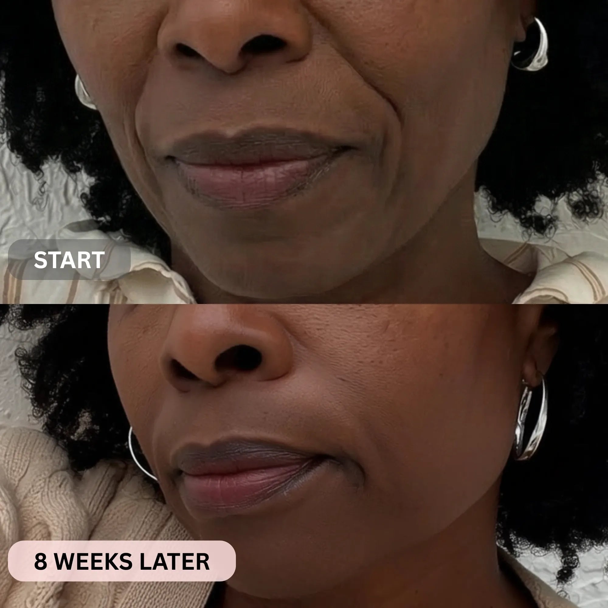 Micro - Infusion System For Smile Lines PDRN + Copper Peptide + NAD⁺ - Botanique Paris