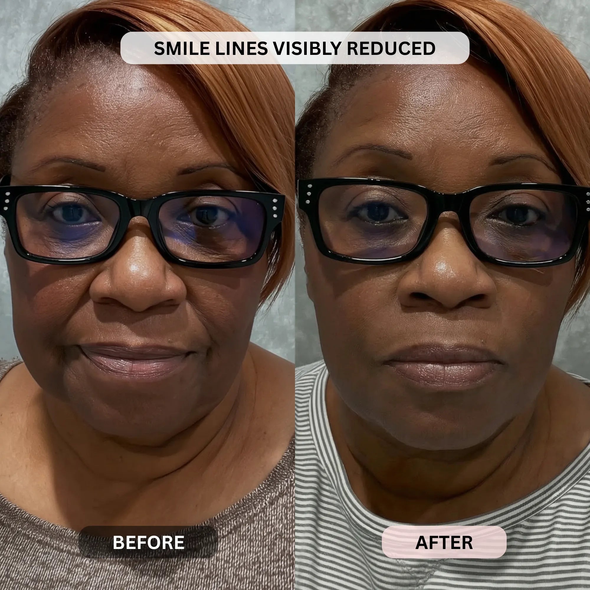 Micro - Infusion System For Smile Lines PDRN + Copper Peptide + NAD⁺ - Botanique Paris