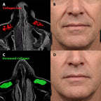 Micro - Infusion System For Smile Lines (Men) - Botanique Paris