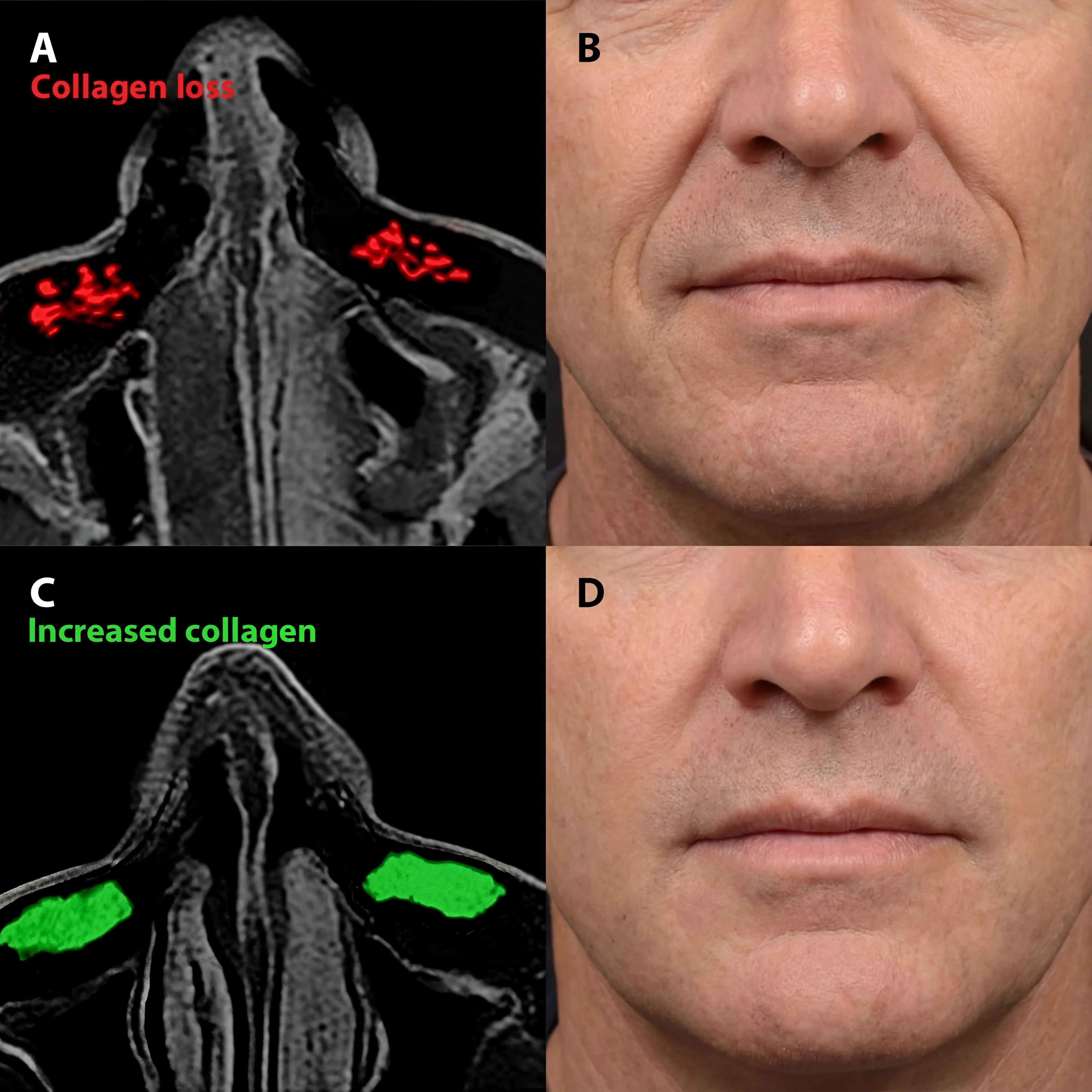 Micro - Infusion System For Smile Lines (Men) - Botanique Paris
