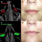 Micro - Infusion System For Smile Lines - Botanique Paris