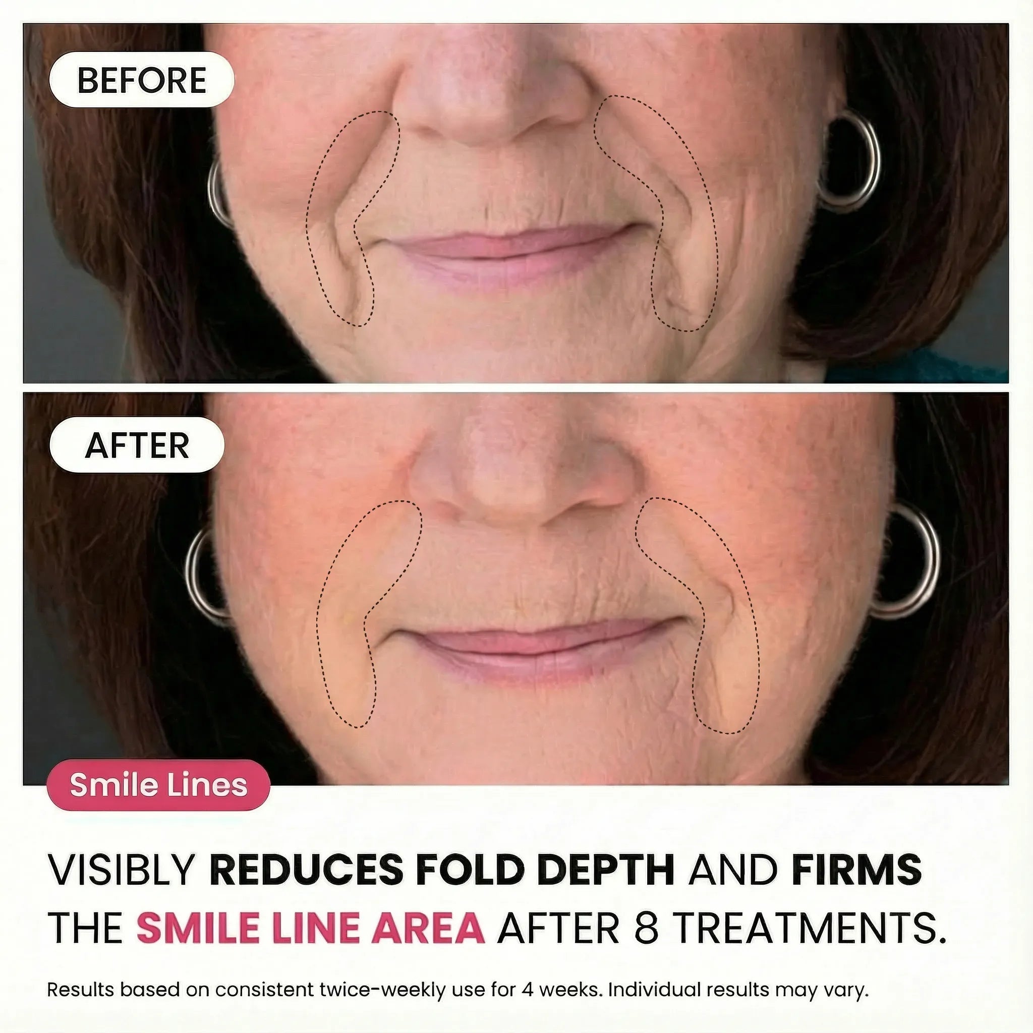 Micro - Infusion System For Smile Lines PDRN + Copper Peptide + NAD⁺ - Botanique Paris