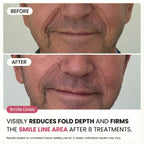 Micro - Infusion System For Smile Lines (Men) - Botanique Paris