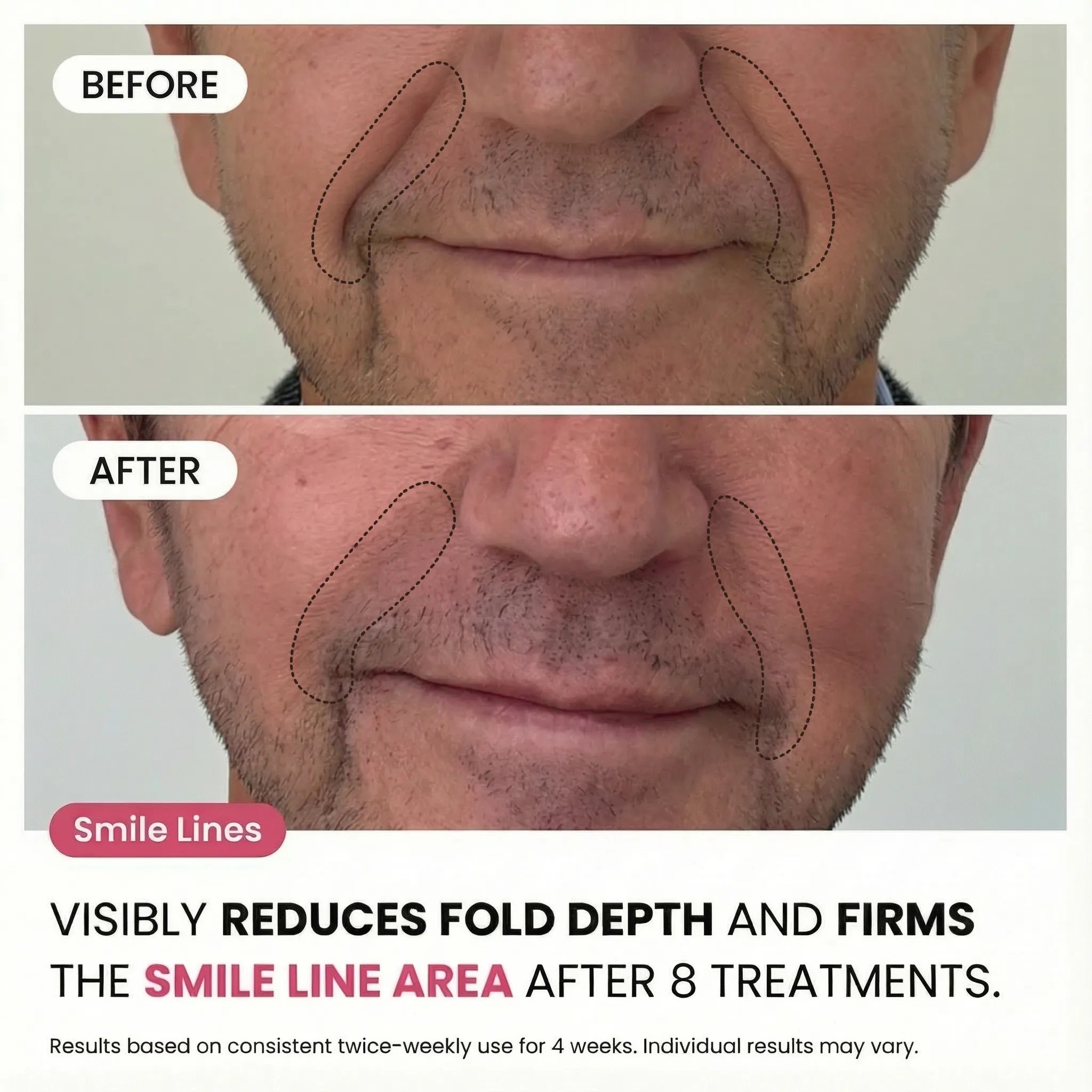 Micro - Infusion System For Smile Lines (Men) - Botanique Paris