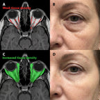 Micro - Infusion System For Under Eyes - Botanique Paris