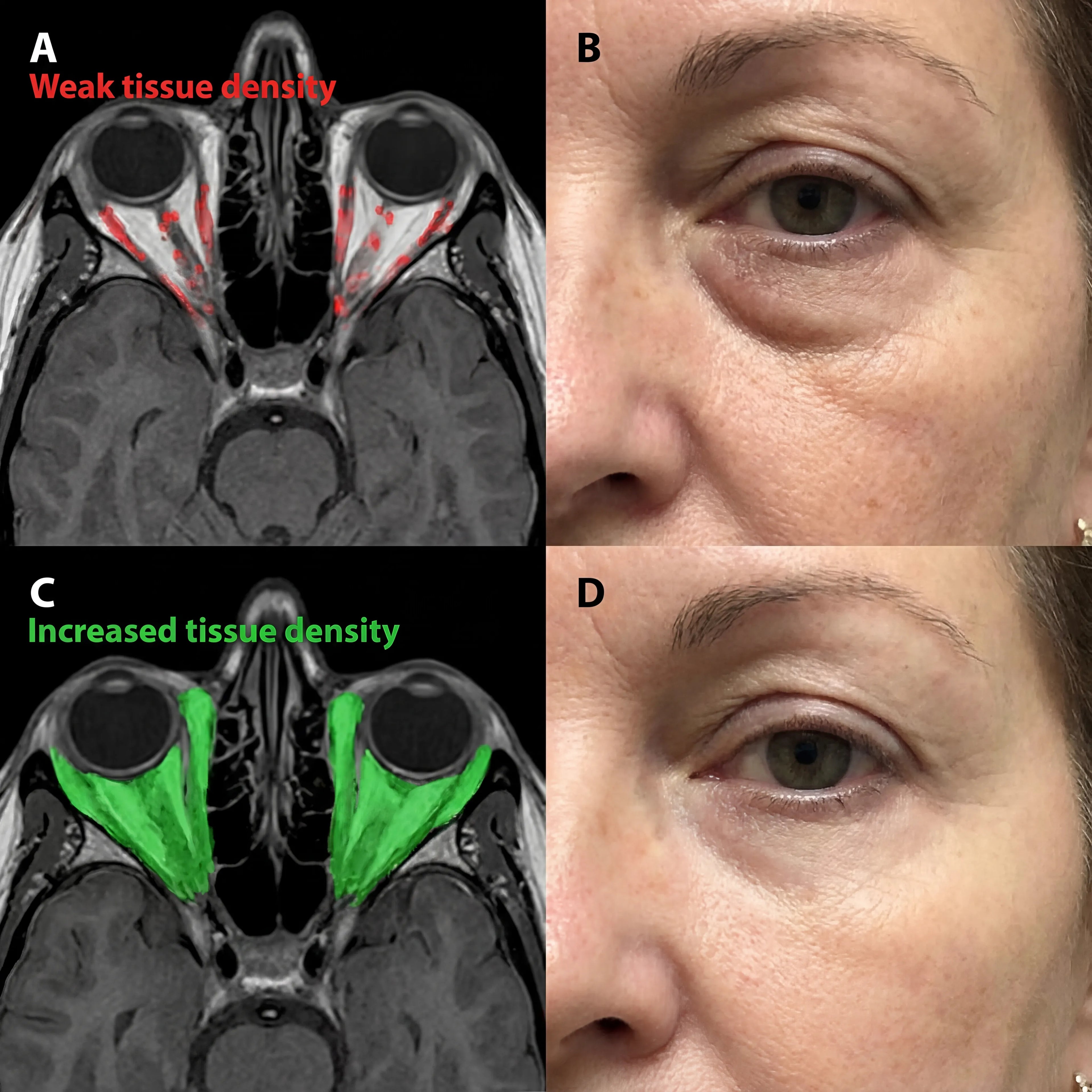 Micro - Infusion System For Under Eyes - Botanique Paris