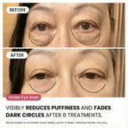 Micro - Infusion System For Under Eyes (Women) - Botanique Paris