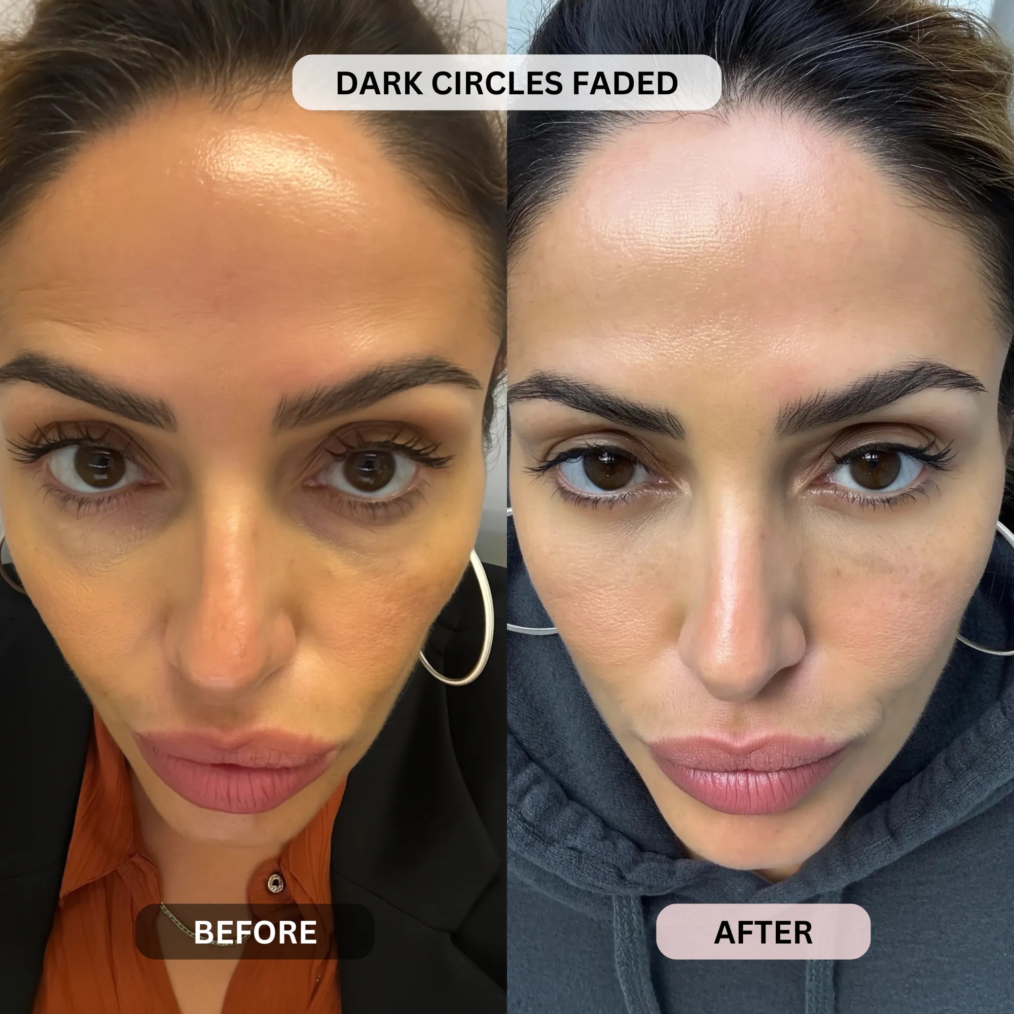 Micro - Infusion System For Under Eyes (Women) - Botanique Paris