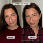 Micro - Infusion System For Upper Eyelids - Botanique Paris