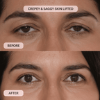 Micro - Infusion System For Upper Eyelids - Botanique Paris