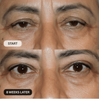Micro - Infusion System For Upper Eyelids - Botanique Paris